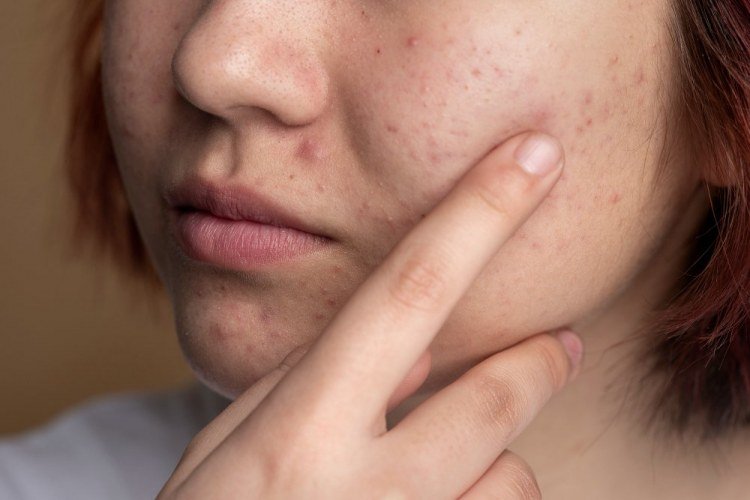 Dieta rica em antioxidantes pode melhorar acne, aponta estudo​‌​