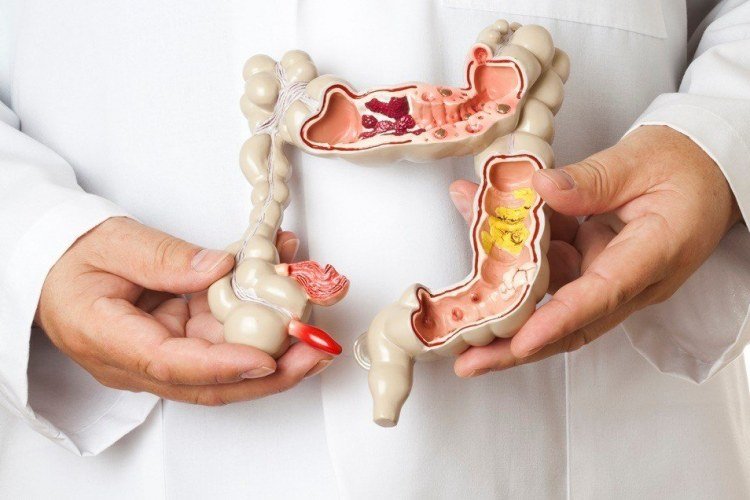 Câncer de intestino em jovens: médicos alertam para aumento de casos​‌​