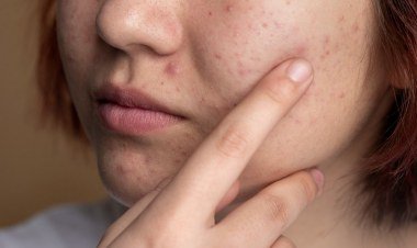 Dieta rica em antioxidantes pode melhorar acne, aponta estudo​‌​