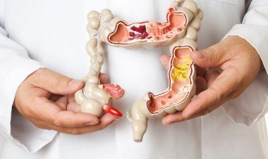 Câncer de intestino em jovens: médicos alertam para aumento de casos​‌​
