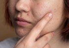 Dieta rica em antioxidantes pode melhorar acne, aponta estudo​‌​