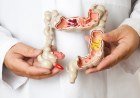 Câncer de intestino em jovens: médicos alertam para aumento de casos​‌​